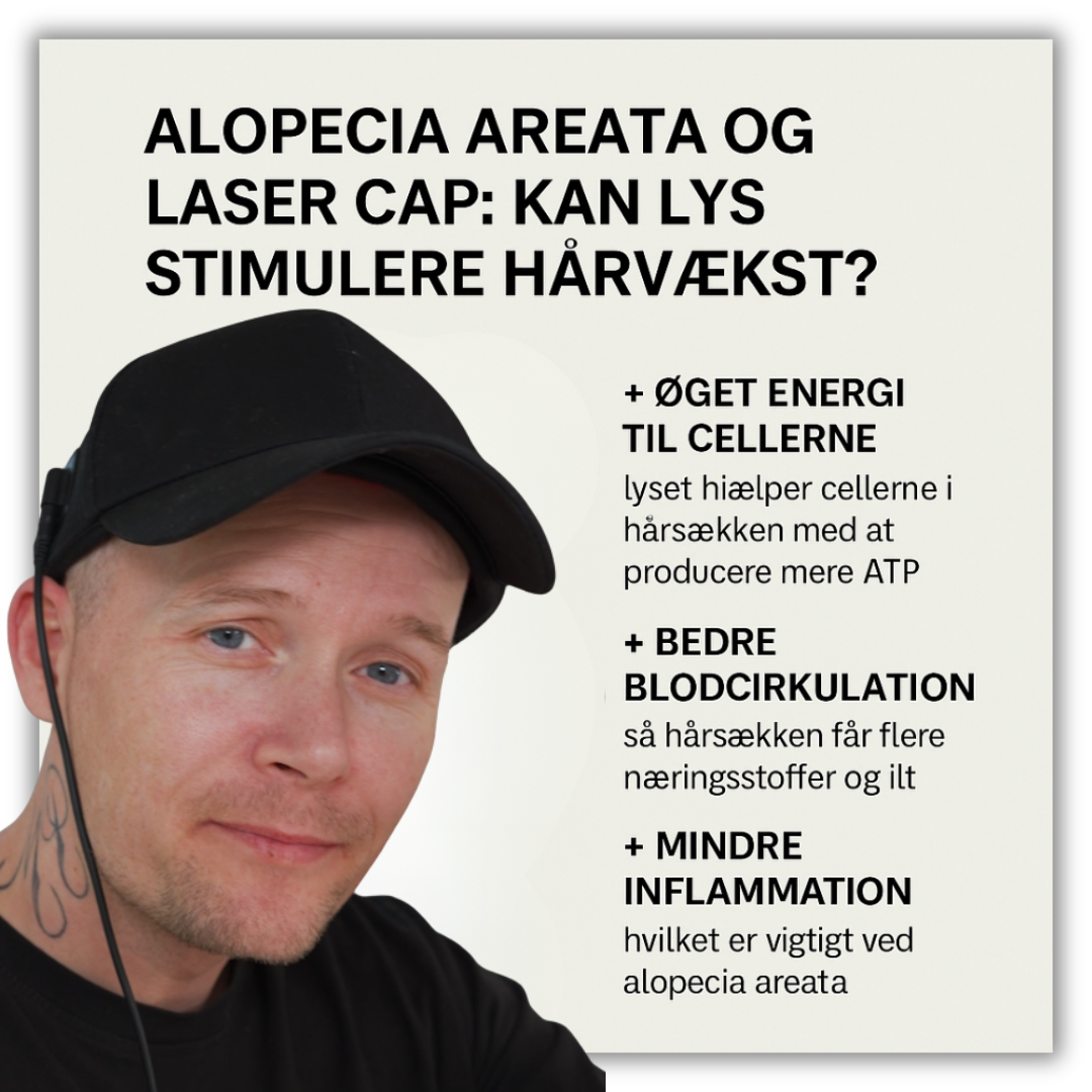 Alopecia Areata og Laser Cap: Kan lys stimulere hårvækst?